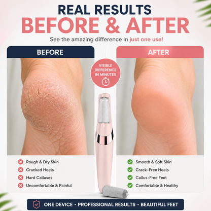 Electric Pedicure Foot File Callus Remover – Rechargeable Foot Care Device